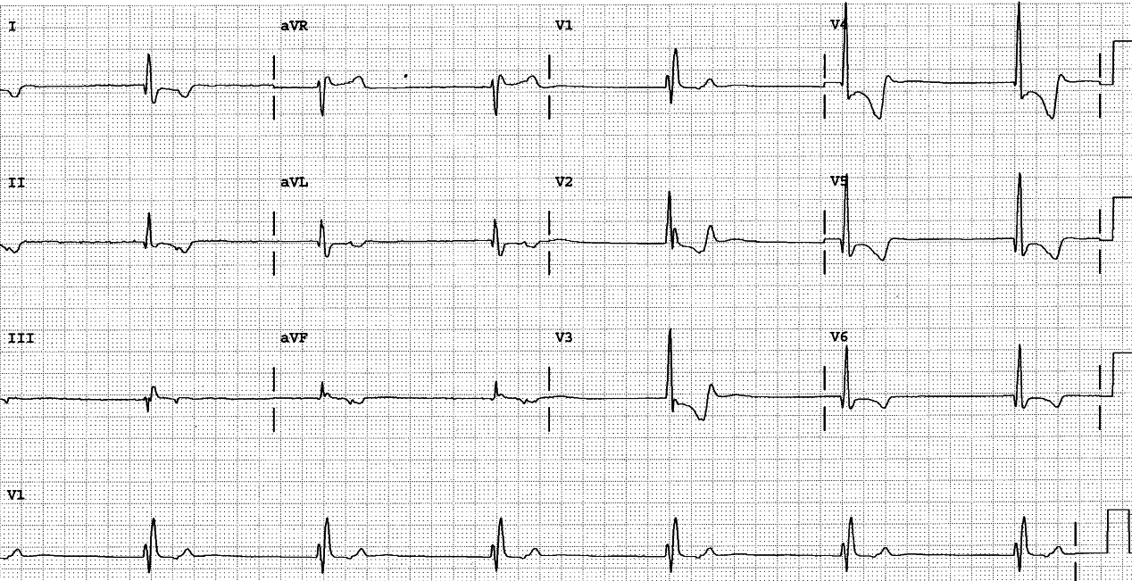 82 year old man with history of myocardial infarctions and bradycardia. 