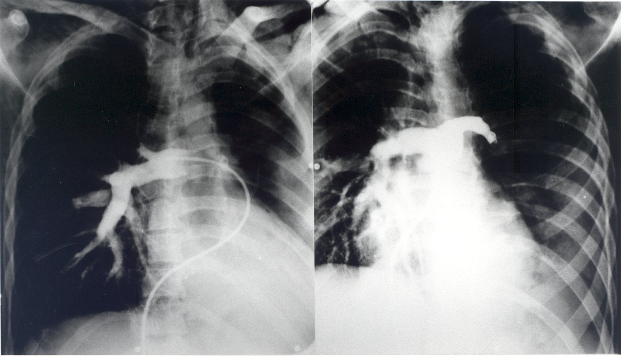 Pulmonary angiogram.