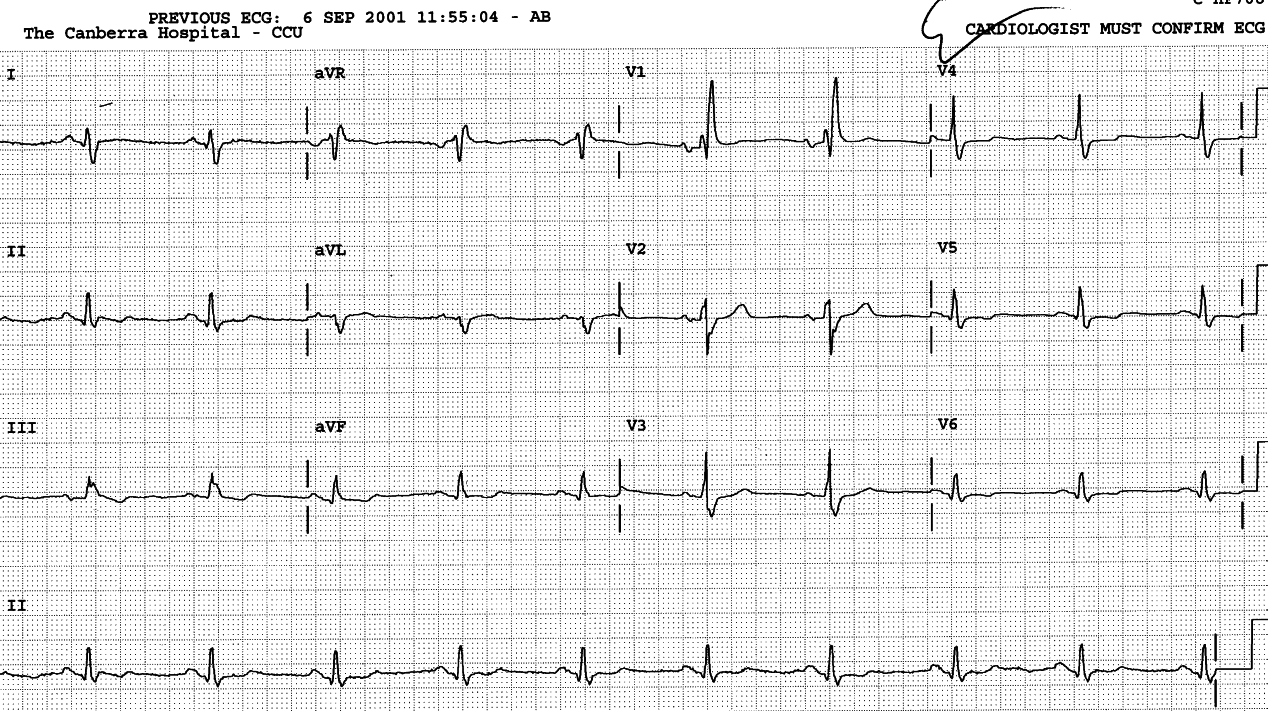 Baseline ECG. The Q wave in V6 is 1 mm wide.