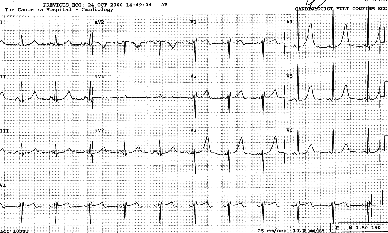 51 year old lady waiting for aortic valve replacement. AS or AI?