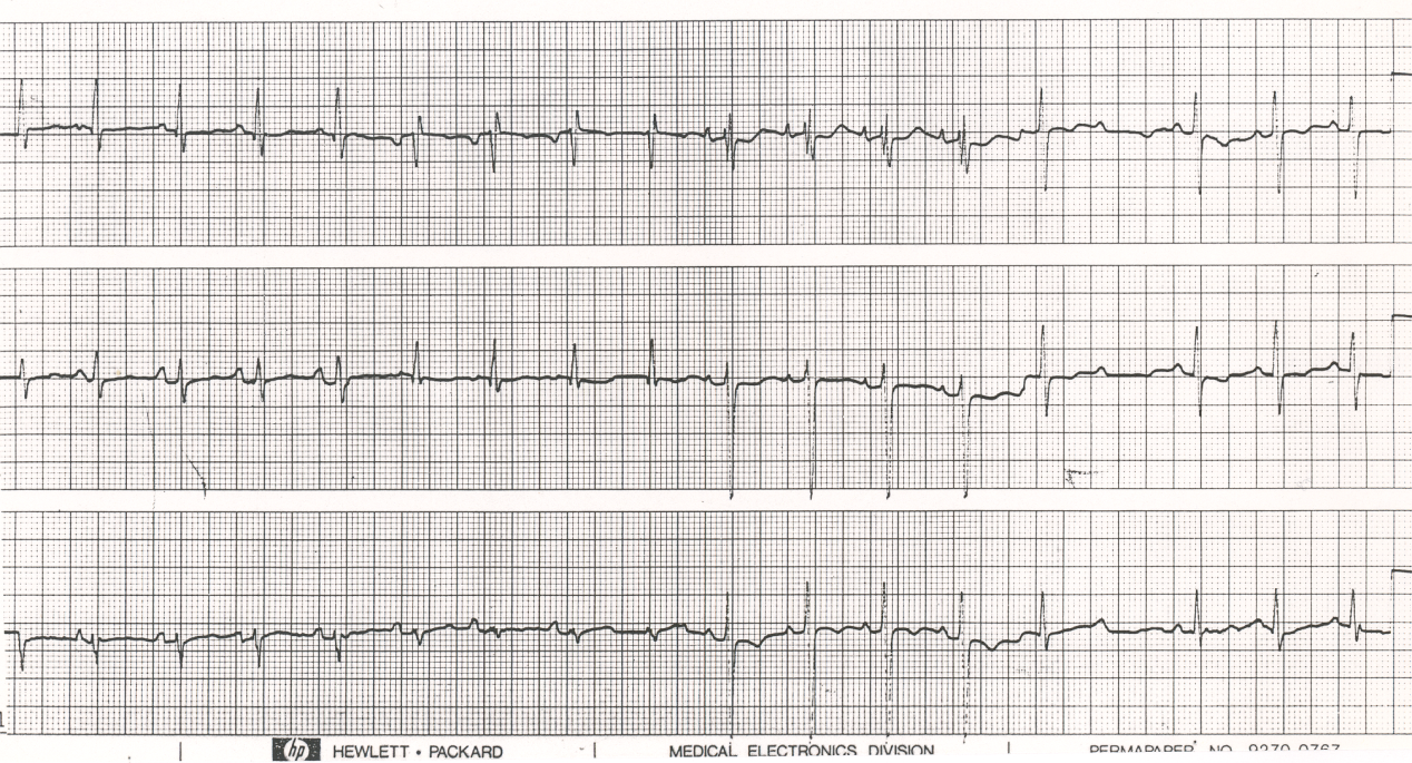 71 year old with chronic CCF and an unusual electrocardiographic (non)event