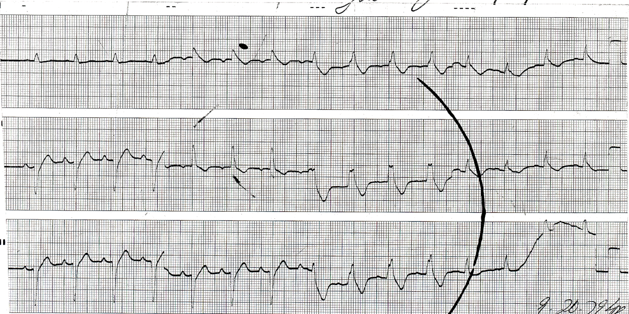 78 year old man on digoxin and quinidine for episodes of atrial fibrillation (Lead 2 continuous recording) 