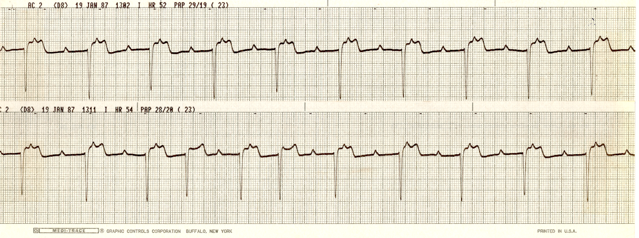 55 year old man on steroids and cyclosporine, complaining of palpitations in CCU. 