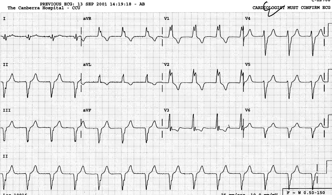 Similar AIVR three years earlier, without the acute repolarisation changes.