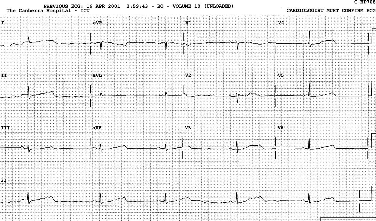 77 year old lady found unconscious by her husband after taking 6 x 160mg sotalol tablets