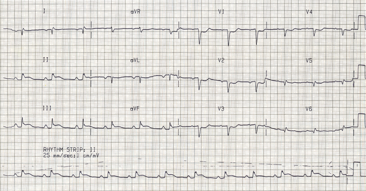 56 year old man with severe chest pain. Where in the chest was it?