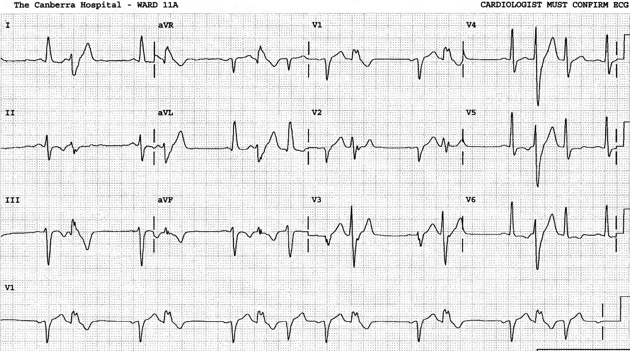 Same patient as in Fig 129b. Bigeminy transformed by concealed retrograde conduction instead of retrograde block. 