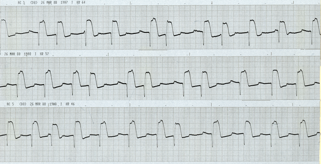 Someone put a hot plate on this ECG, probably during a night shift, adding to the masquerade. This type of masquerading BBB is called standard and precordial since both sets of leads â standard and left precordial â resemble LBBB. Lead V1 and marked LAD tell the true story: RBBB + marked LAHB. 