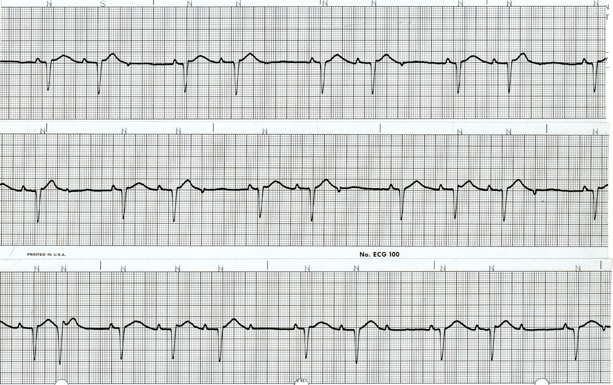 Day 14 of extensive inferolateral infarction with evidence of low cardiac output on dobutamine drip. What is the treatment of choice? 