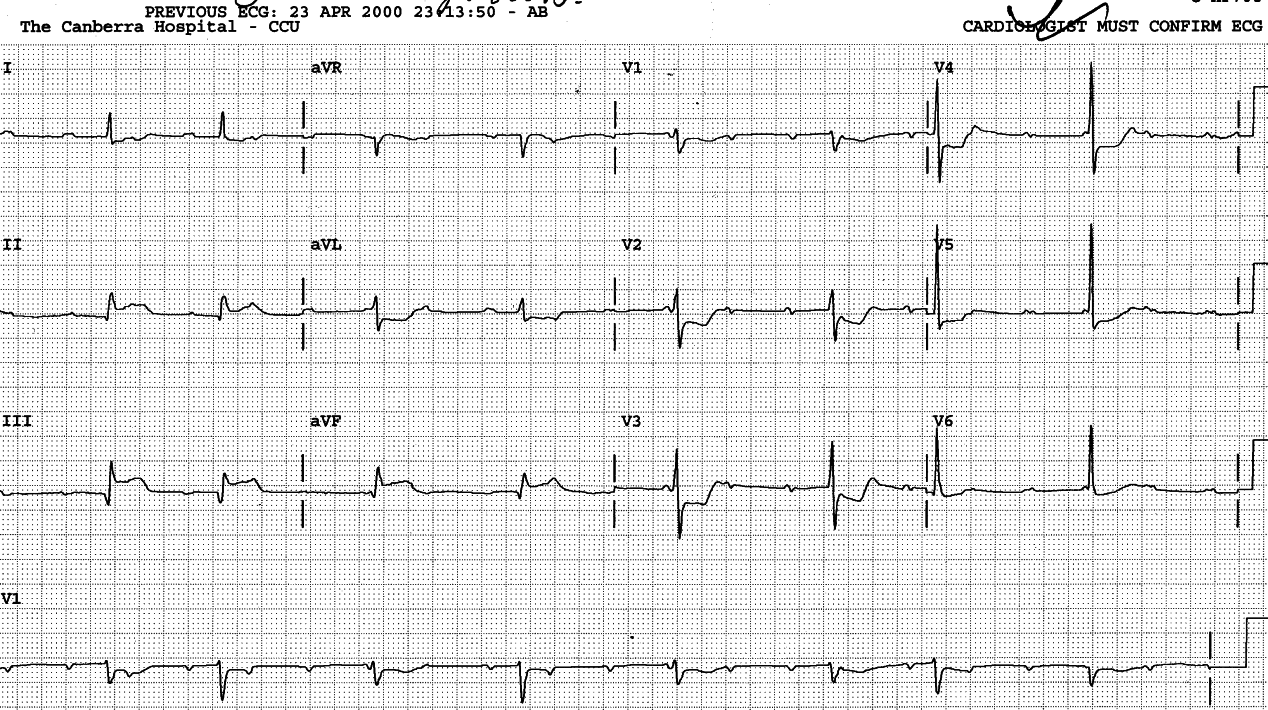 60 year old man with chest pain and irregular pulse.