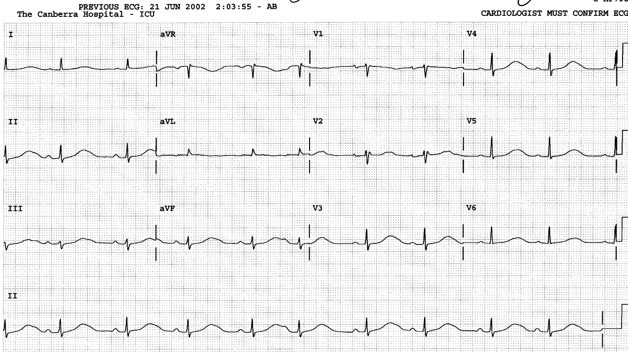 The shortest cycle is due to a SVEB â even though its PâR interval is longer than sinus PR intervals.