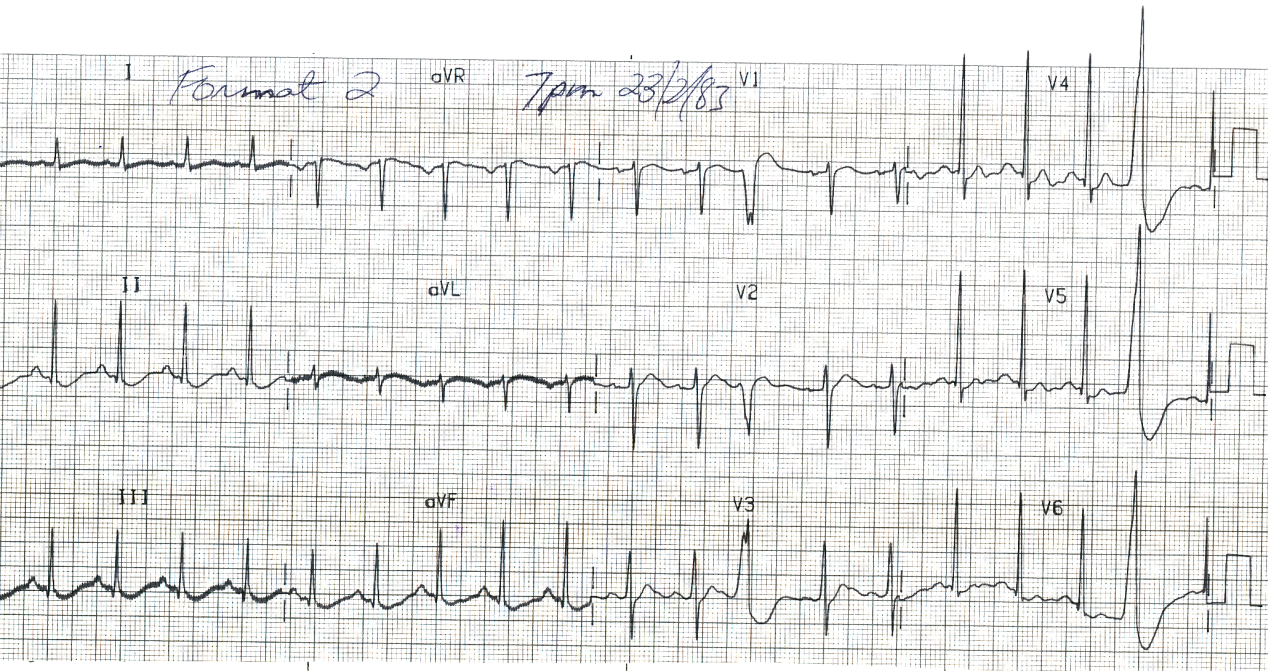 Polyuric (over 50 L/day) 71 year old lady with breast carcinoma. She recently started tamoxifene treatment.