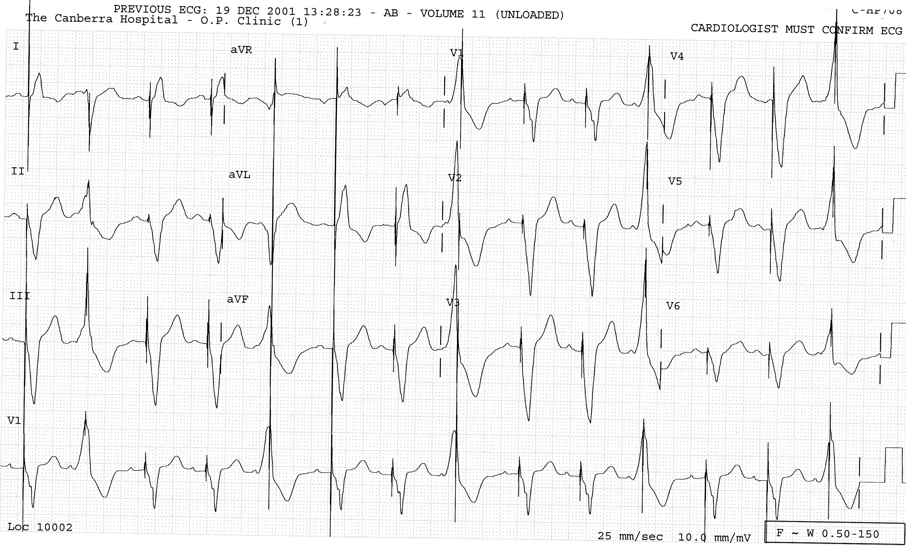 77 year old lady in the Pacemaker Clinic for a routine
check.