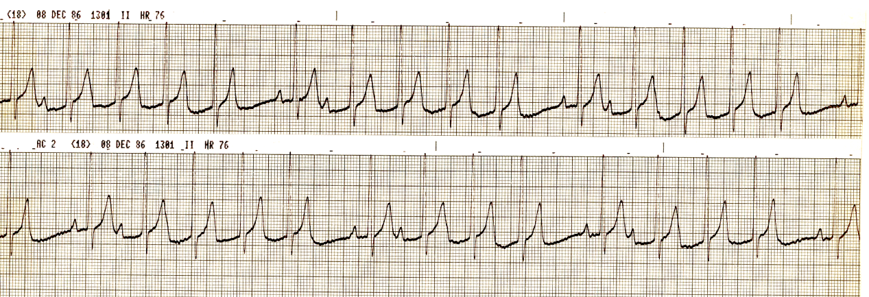 53 year old man on Day 3 of a large inferoposterolateral     infarction. What makes the left anterior descending artery     disease a likely part of his predicament? 