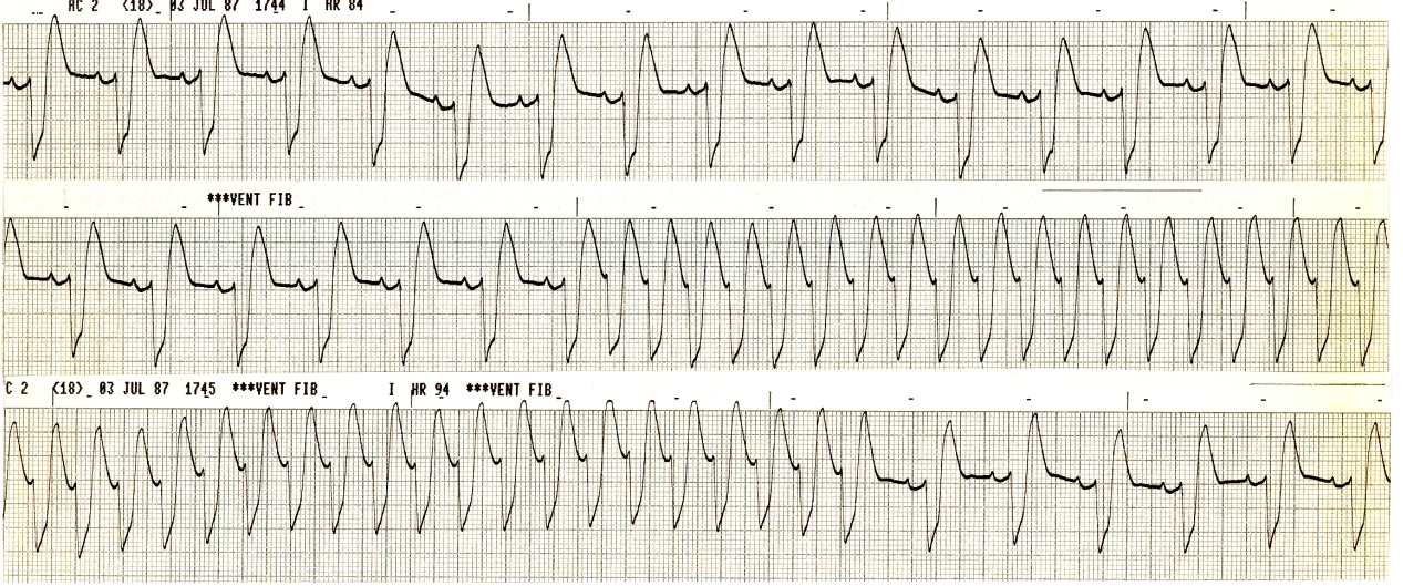 Atrial pacing strip. 