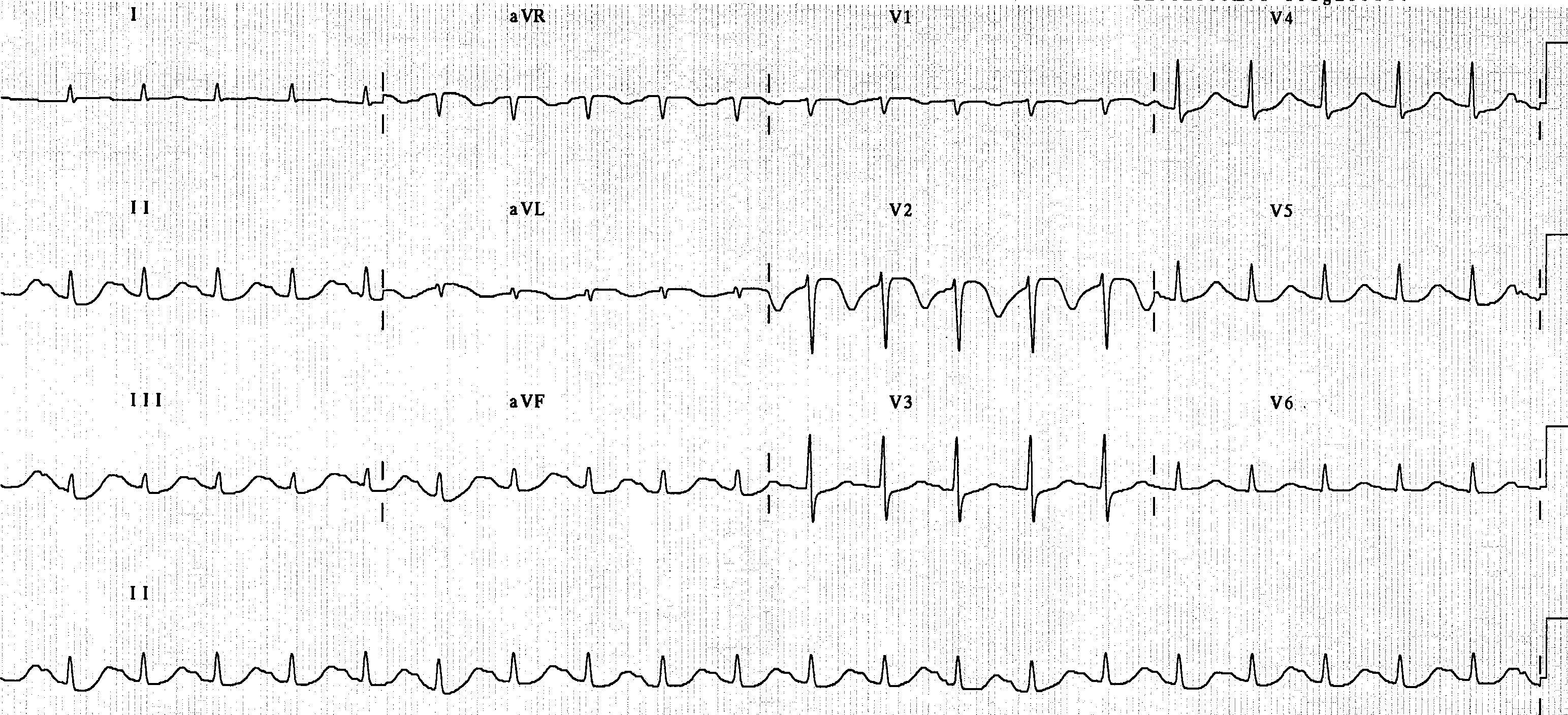 21 year old lady ventilated for severe pneumonia; she was started on IV erythromycin to promote enteral nutrition.