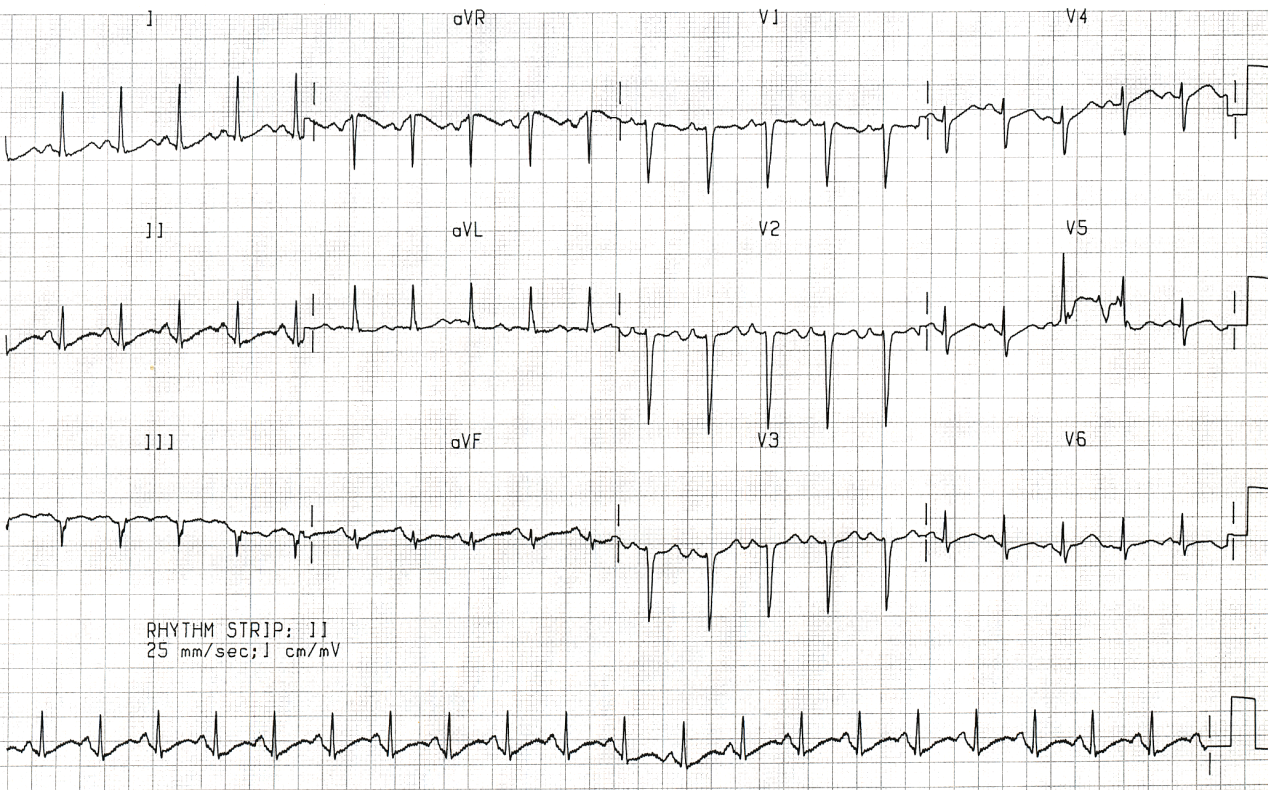 QT prolongation persists in sinus tachycardia 122/min.