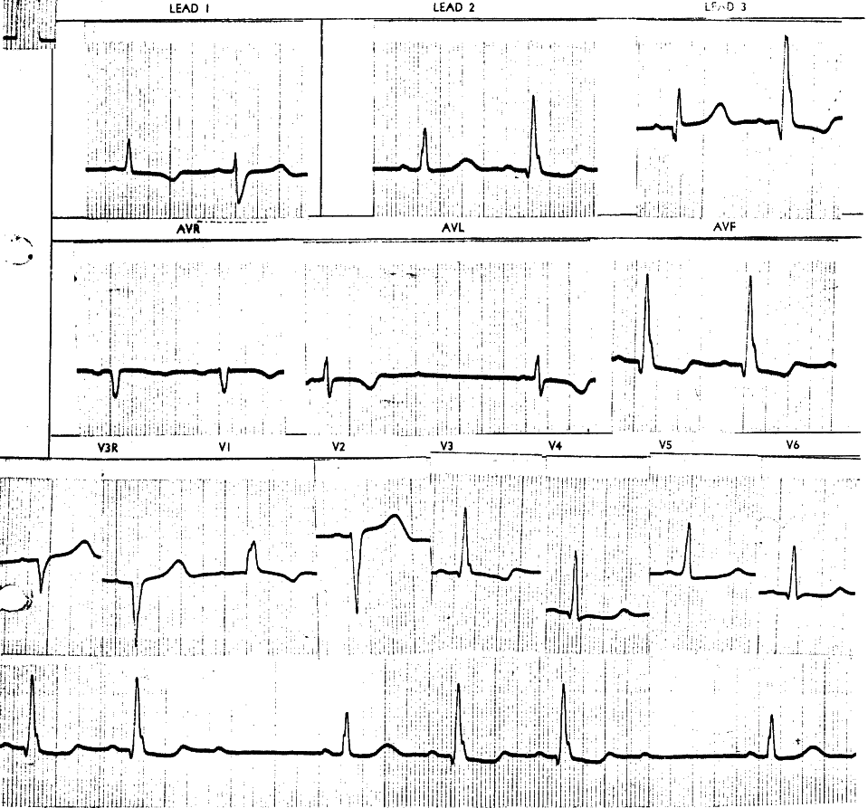 75 year old lady with episodic weakness and giddiness.