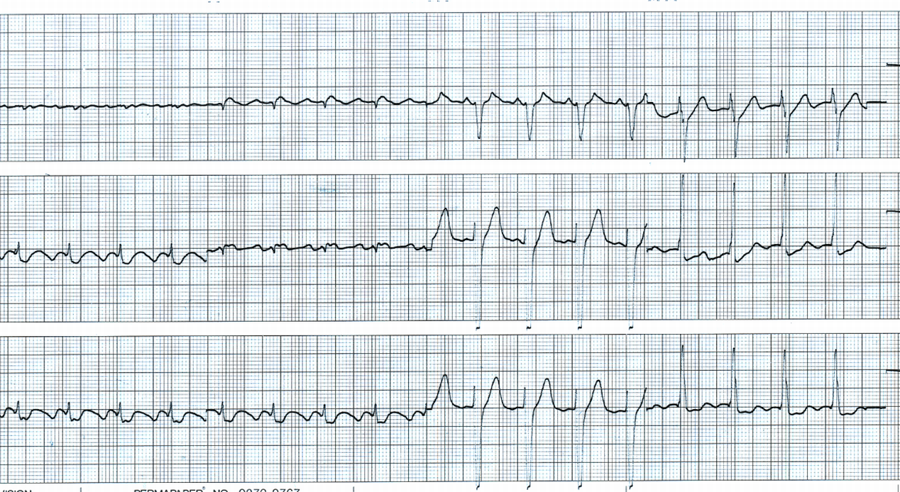 63 year old man with primary congestive cardiomyopathy (COCM)