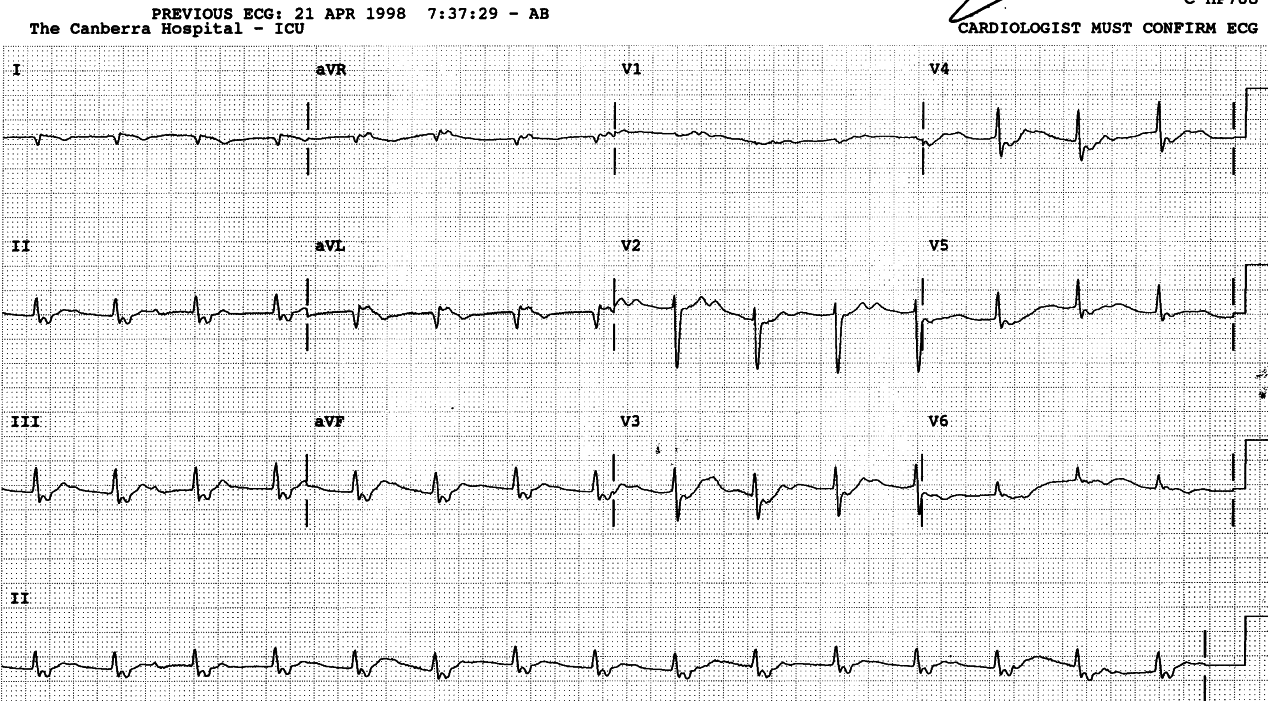 Accelerated junctional rhythm with 1:1 retrograde conduction to     the atria. 