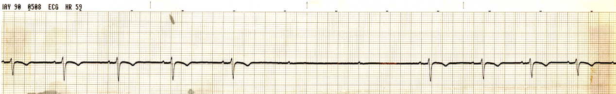 39 year old man on Day 4 of inferior infarction. The tracing below was recorded while he was asleep. Similar episodes while he was awake were asymptomatic. What is to be done?