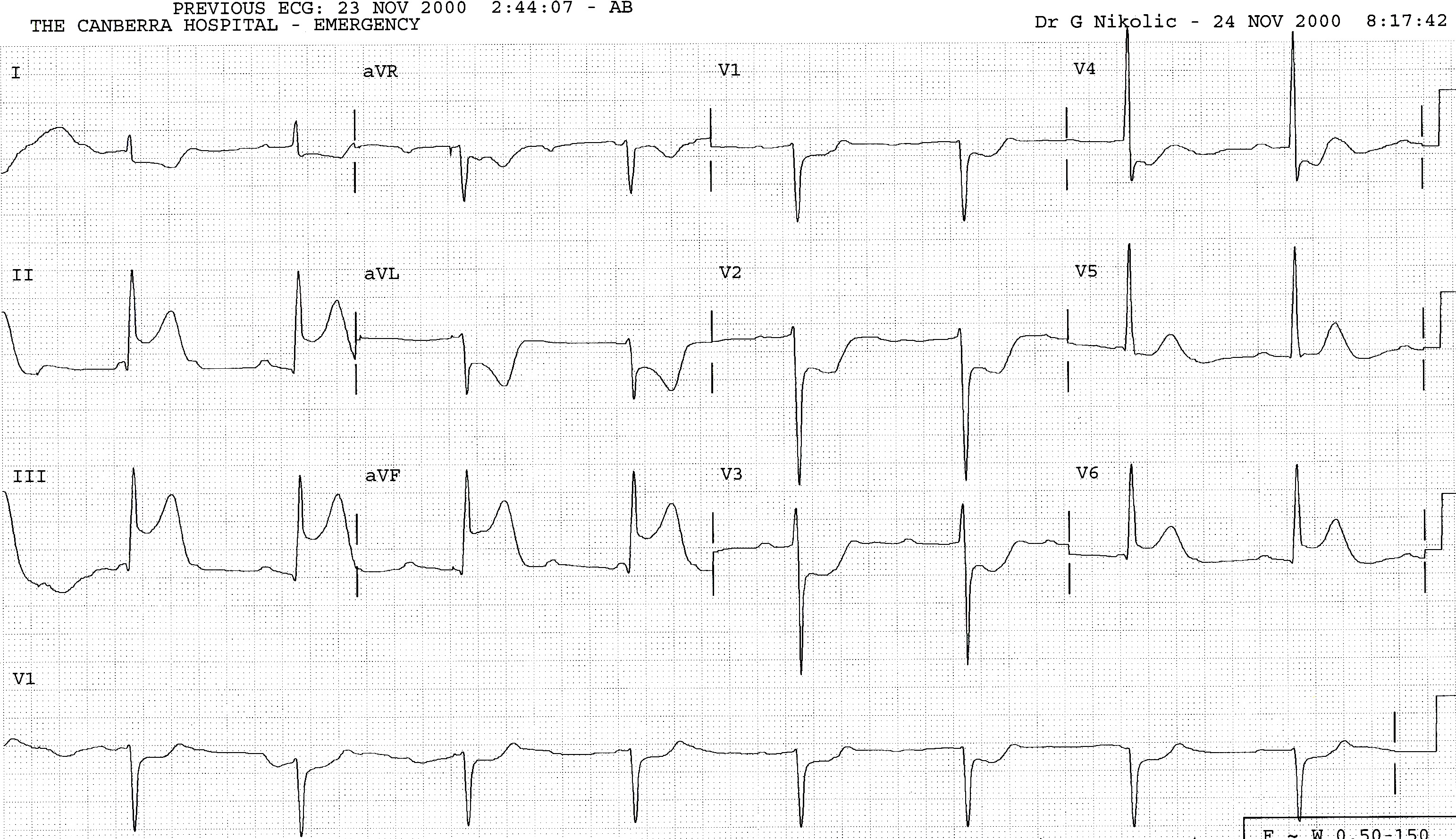 All ST segment shifts are more marked and V6 participates: a large basal infarction. His AV dissociation, however, is more related to infarct location than size.