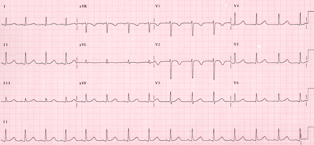 Normalised ECG one week later