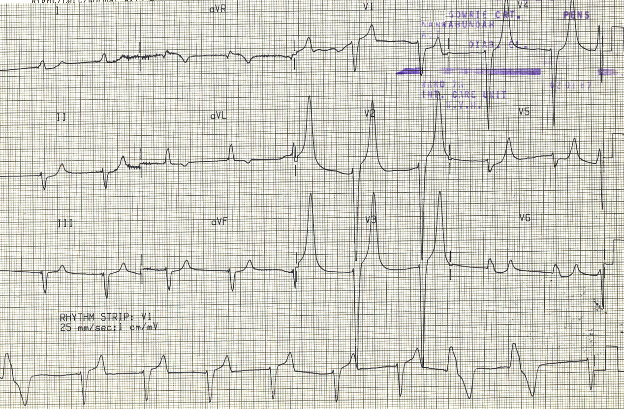 83 year old diabetic in hyperosmolar coma and acute renal failure due to mesenteric gangrene