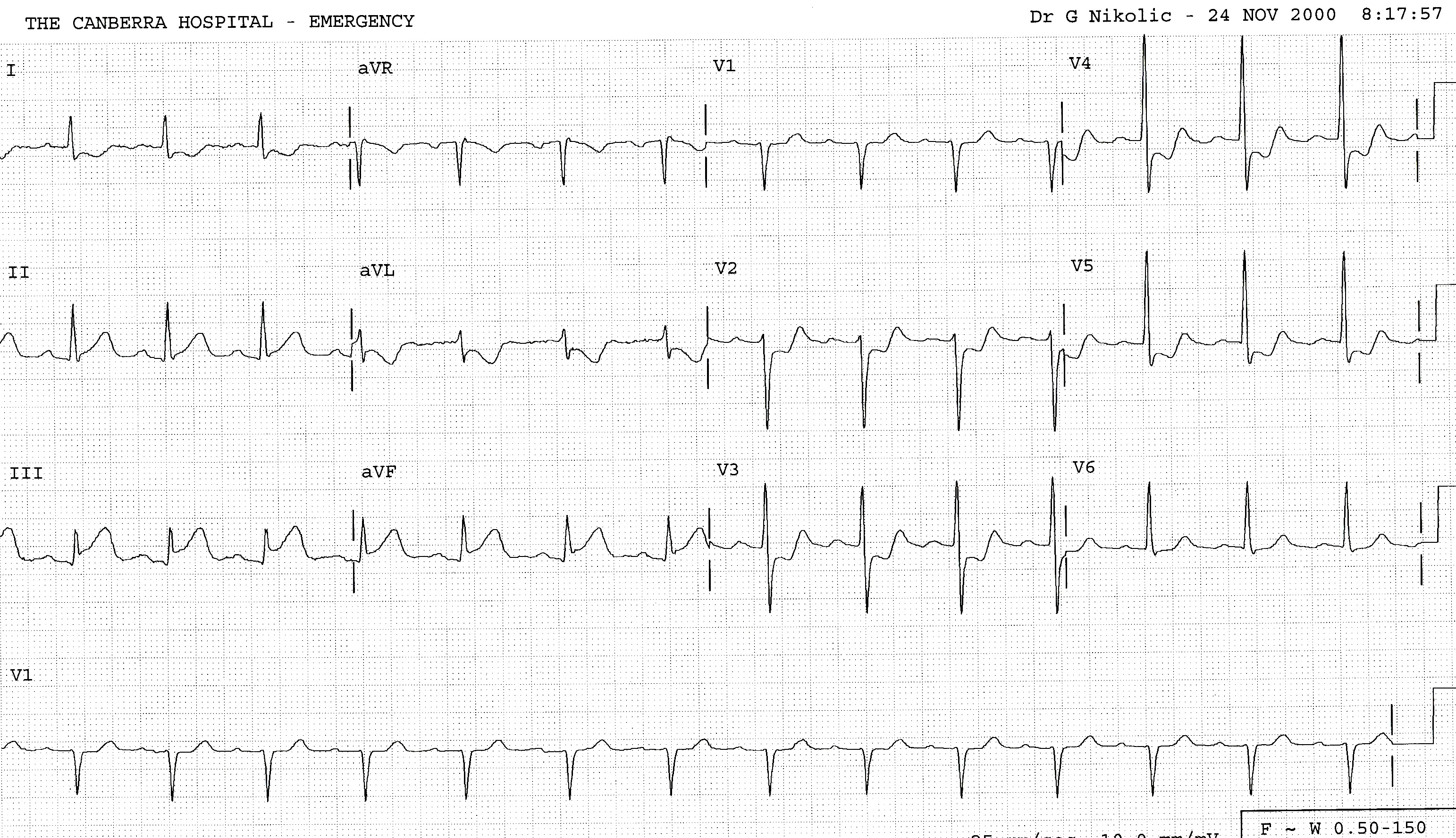 Extensive reciprocal changes imply a large infarction rather than independent ischÃ¦mia. The next trace was even more convincing.