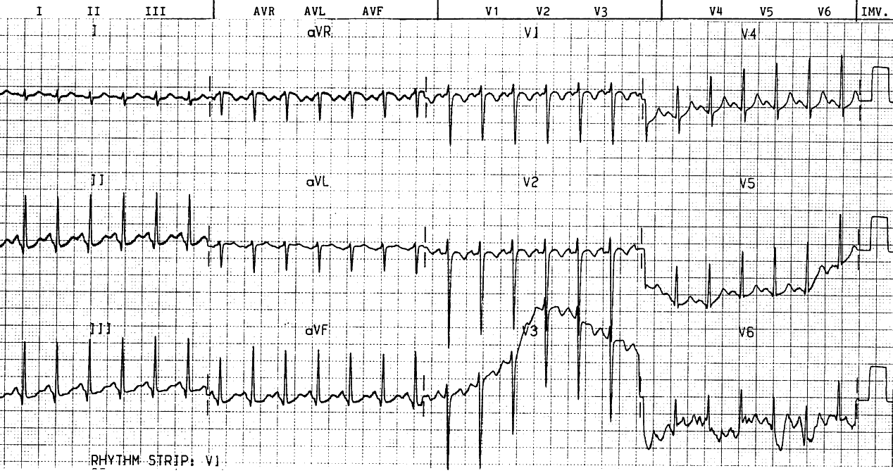 The ST depression is in line with downsloping PR segments, in healthy tachycardia.