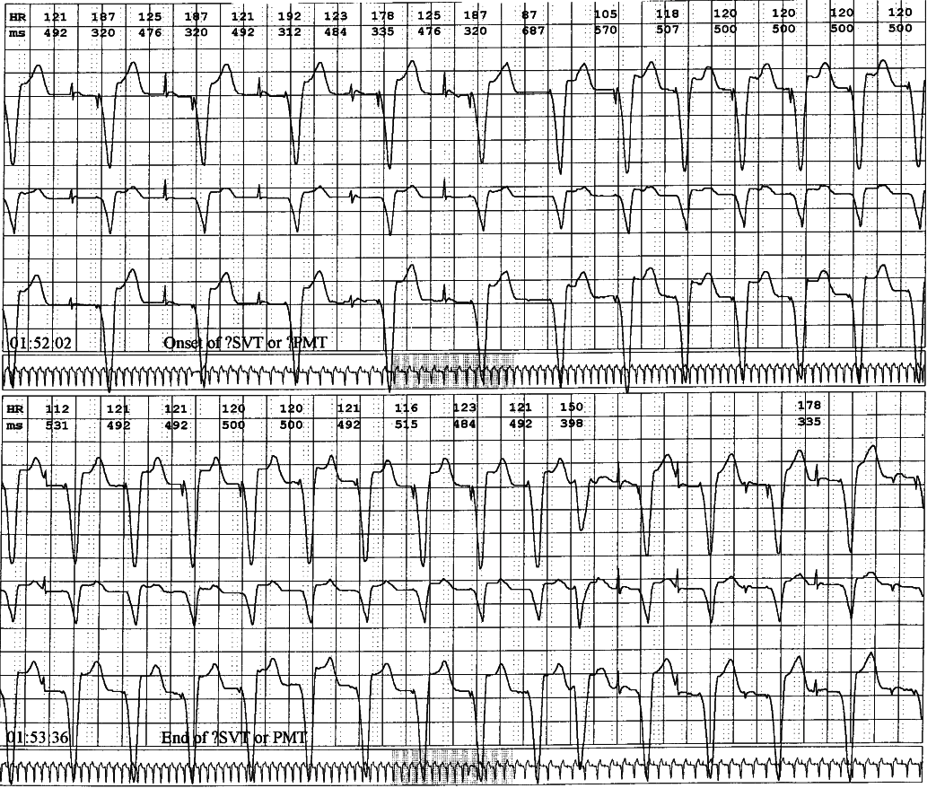 Holter monitor strips (2 panels) of a 88 year old lady with
permanent DDDR pacemaker and recurrent syncopal attacks.