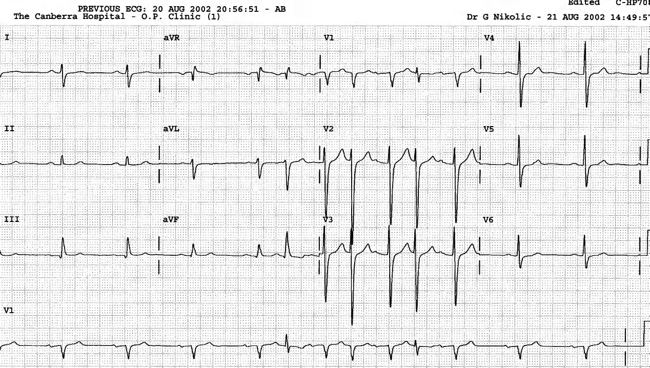 Three junctional â bundle of His â extrasystoles, interpolated; the middle one is hardly at all aberrant. 