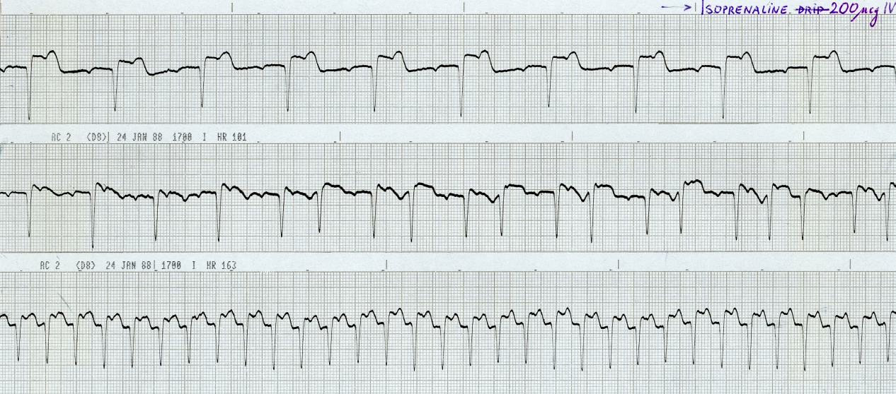 62 year old woman three days after acute inferior infarction, receiving atropine, 1 mg IV, at the end of the middle strip. 