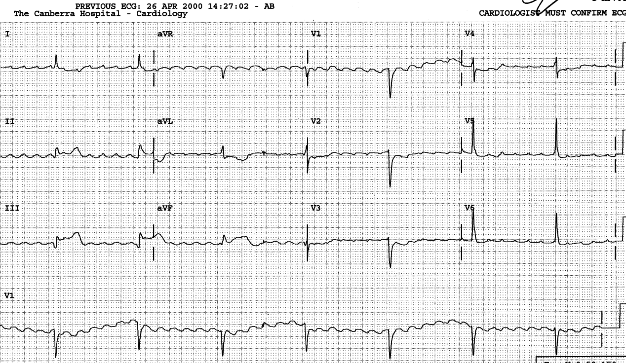 Atrial flutter about 280/min with 3o AVB and junctional escape rhythm 45/min. There is no fixed F-QRS relationship..