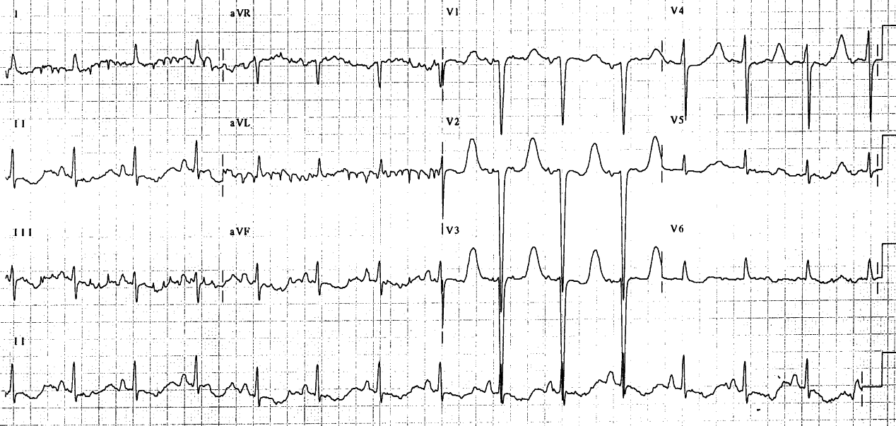 In hyperkalÃ¦mia T waves would move closer to the QRS complex.