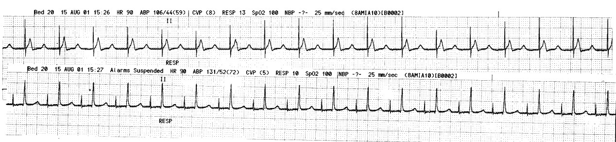 Routine pacing of a 62 year old man following uncomplicated
CABG. The mode is AAI to provide atrial transport and a narrow QRS. The
nursing staff reported intermittent ventricular pacing by the same lead,
with a drop in blood pressure as recorded. Were they right?