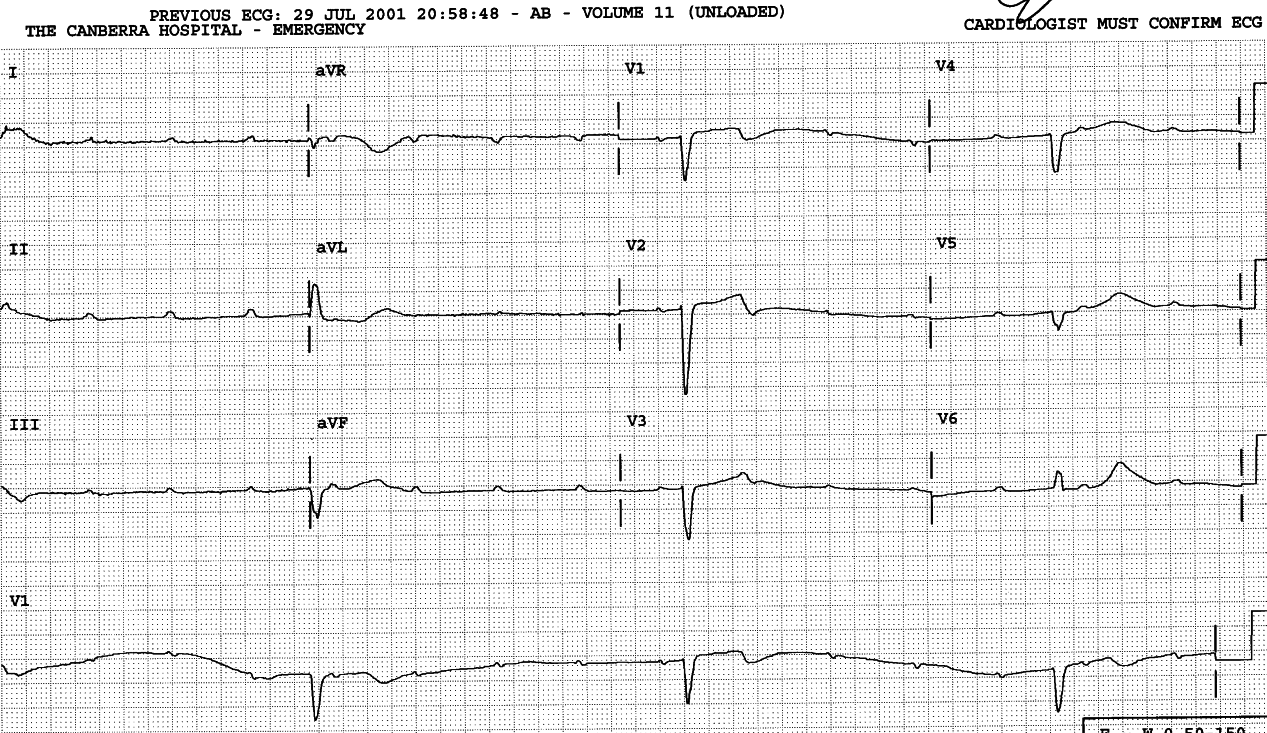 76 year old lady with several daysâ     history of chest pains and grayouts. She was asymptomatic     during the recording shown below.  