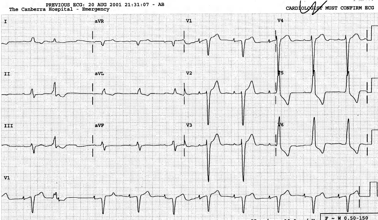 84 year old lady with history of hypertension. 