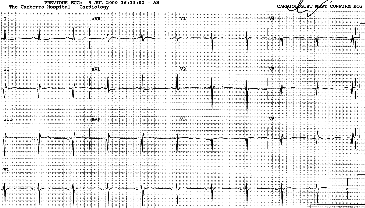 87 year old man with history of myocardial infarction.