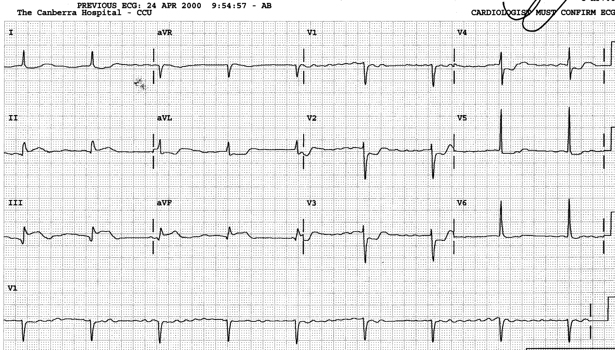 Atrial fibrillation with 3o AVB and junctional escape rhythm 52/min.