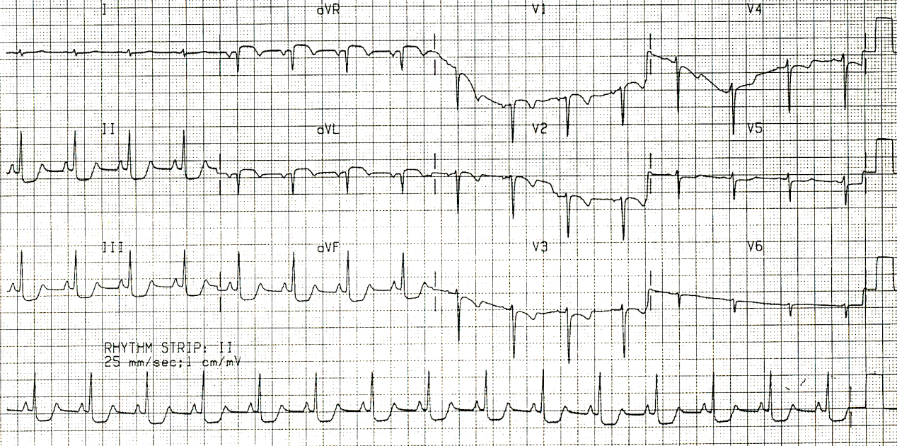 12 year old with status asthmaticus requiring external chest compression and adrenaline to survive