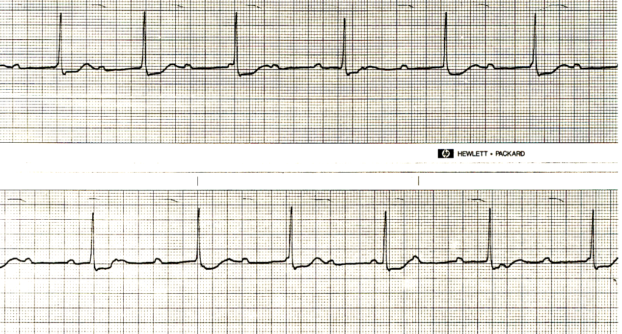 The Bix Rule illustrated in a 55 year old woman with inferior infarction and LVH. If one knows what it is it is easy to see how it is illustrated. 