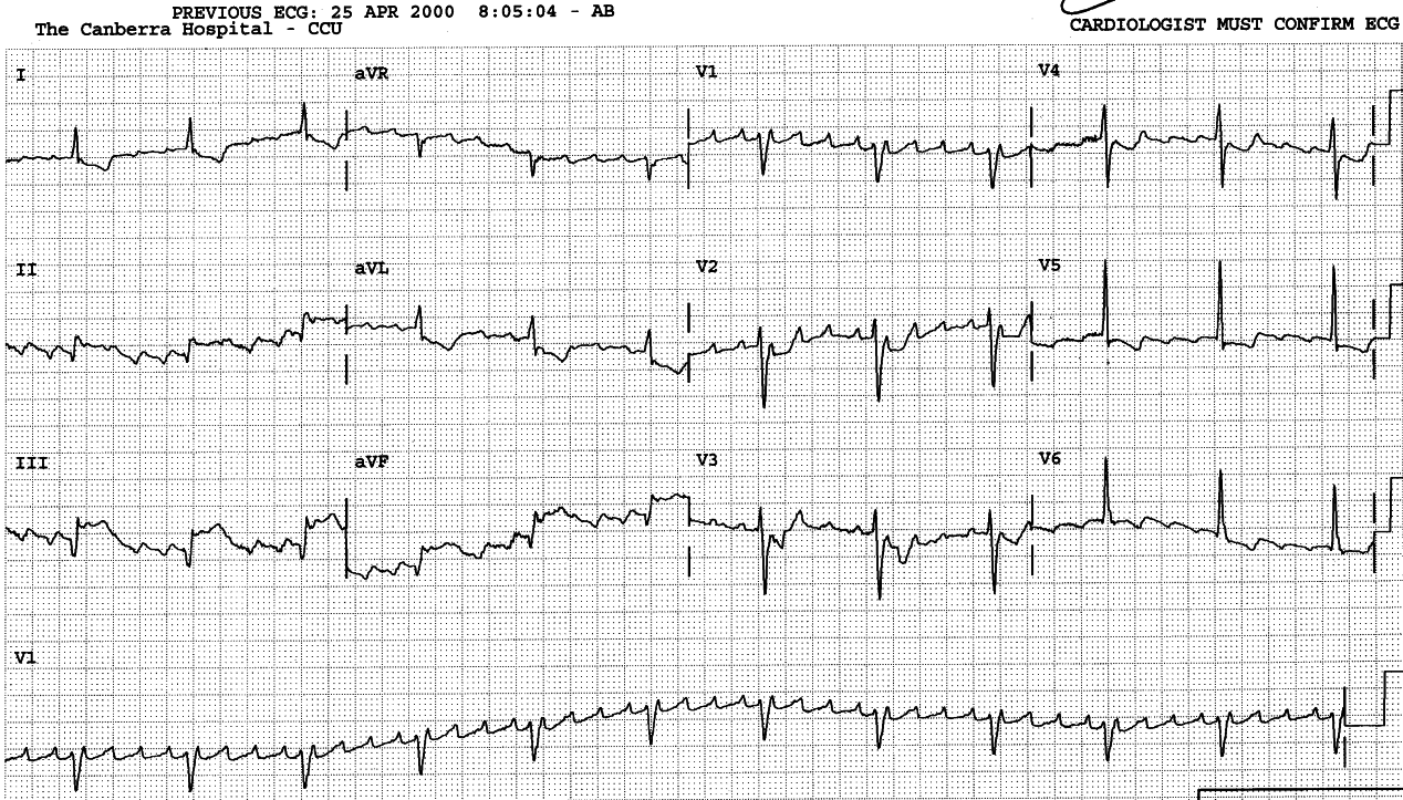 Atrial flutter 280/min with 4:1 AVB. The F-QRS relationship is constant.