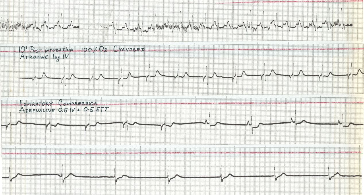 Ten minutes post-intubation resuscitation continued.