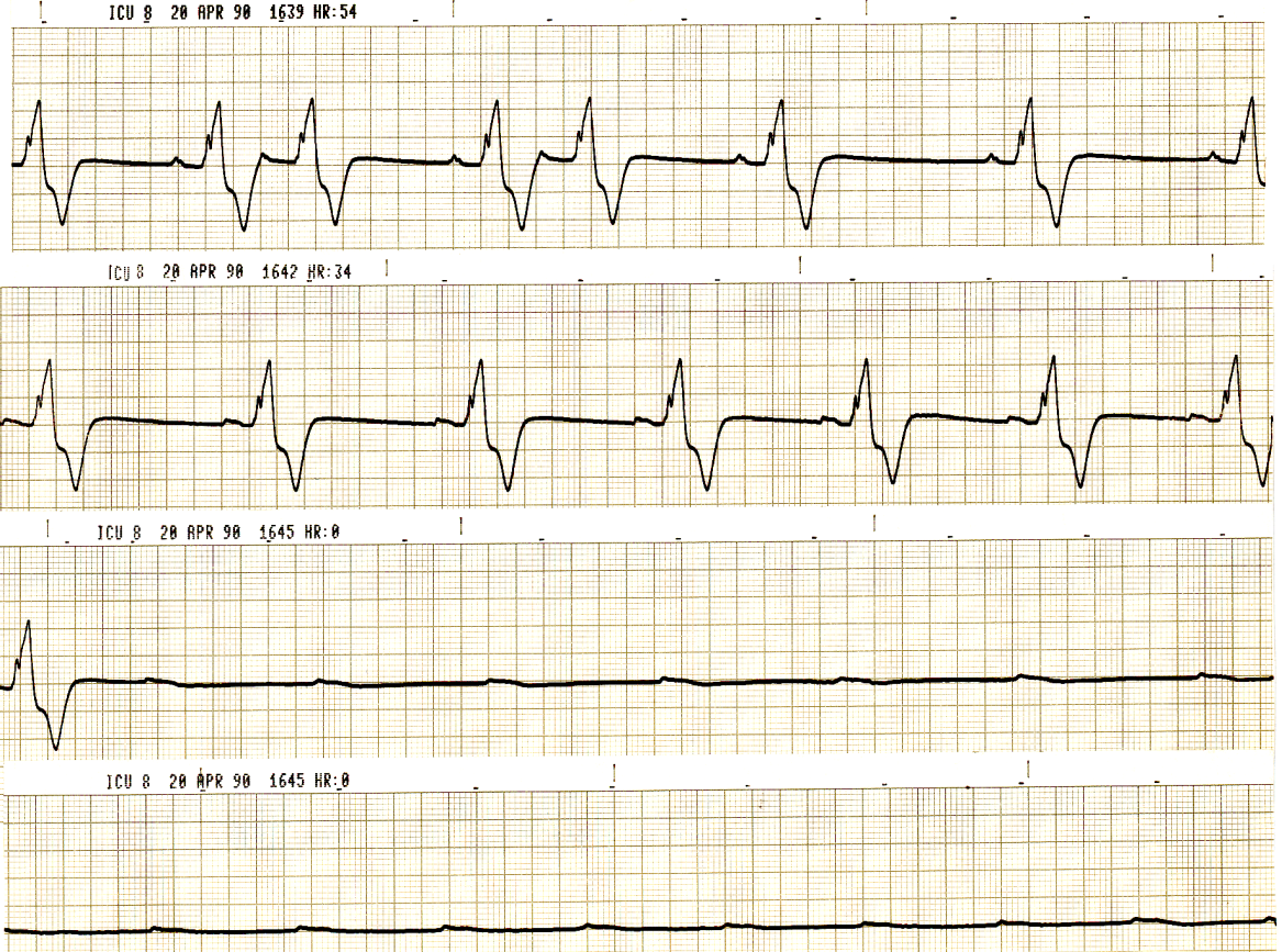 What is the last part of human heart to stop beating? 