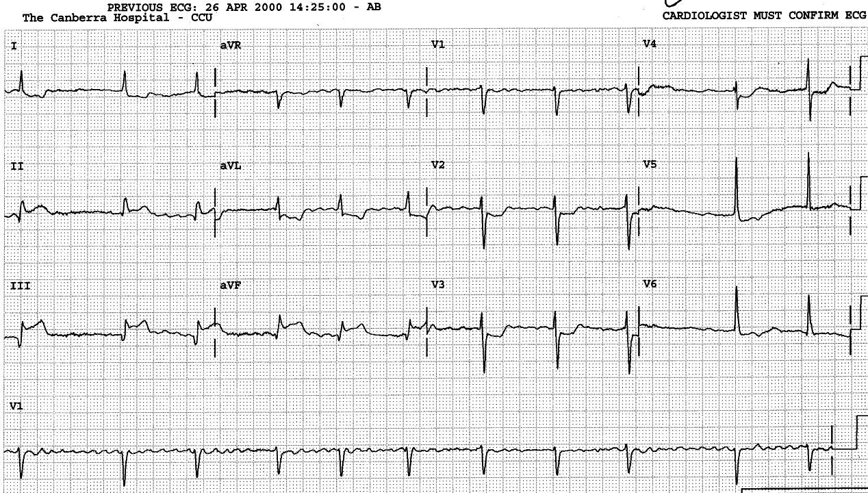 Atrial fibrillation with ventricular response 65/min. The injured AV node plays the role normally reserved for digitalis in controlling the ventricular rate.