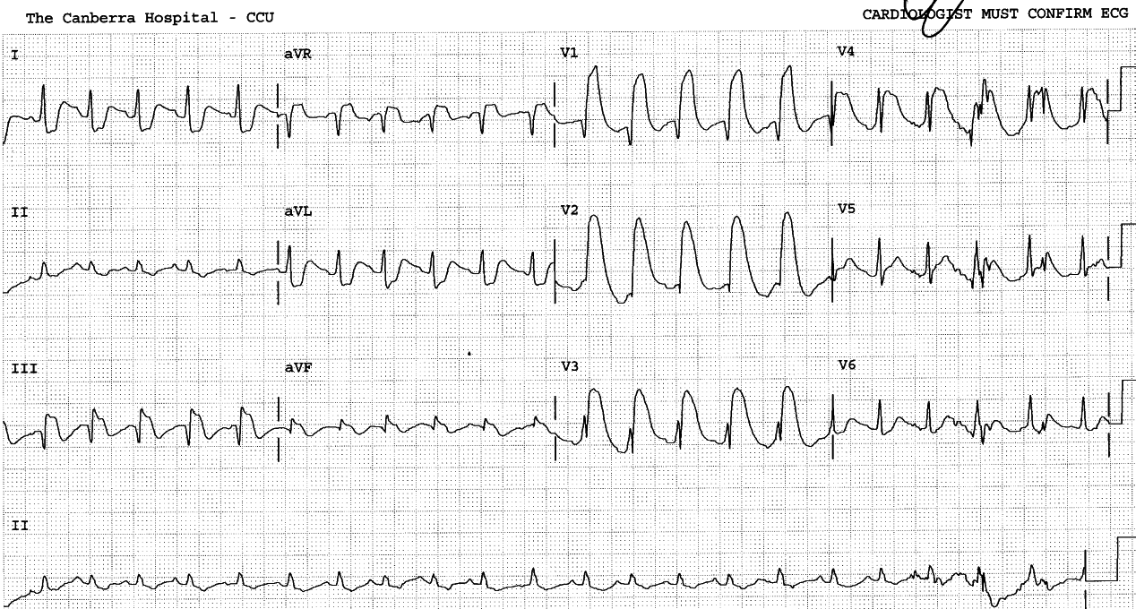 Pre-arrest ECG suggested RV infarction.