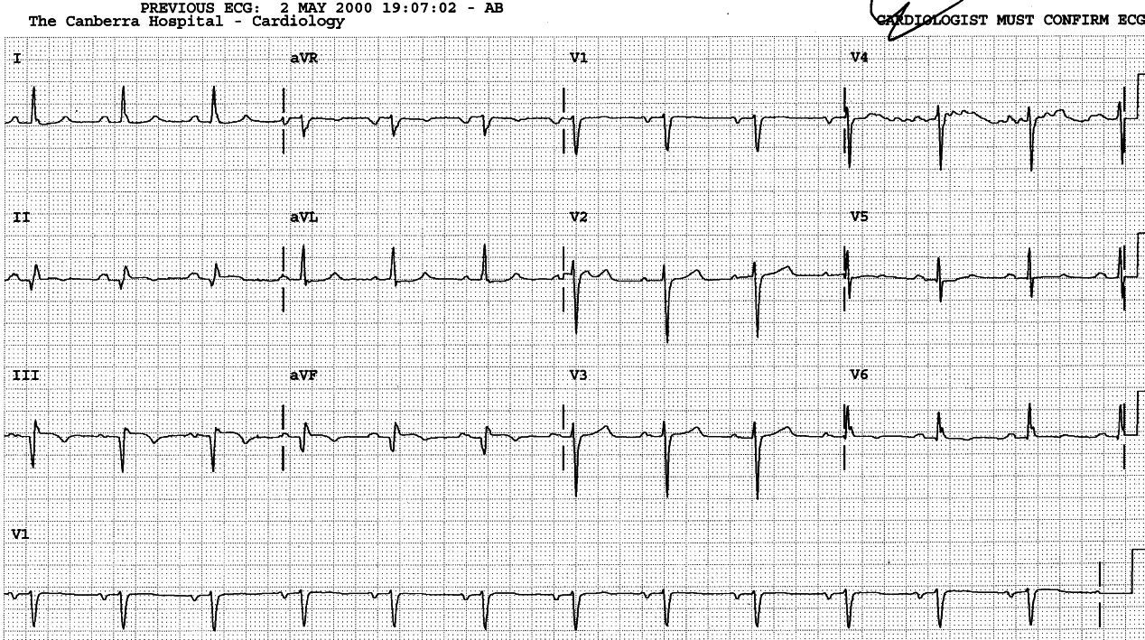 Sinus rhythm 73/min with PR interval just over 0.20â 13 days after admission.