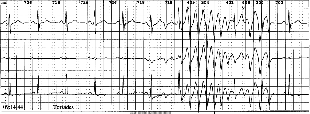 Routine Holter study of a 74 year man with possible arrhythmias