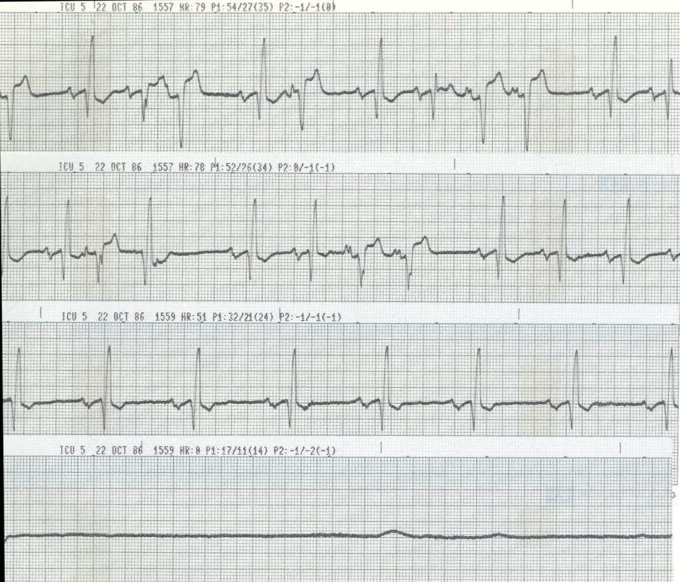 Agonal strips, again showing bradycardia-dependent RBBB.